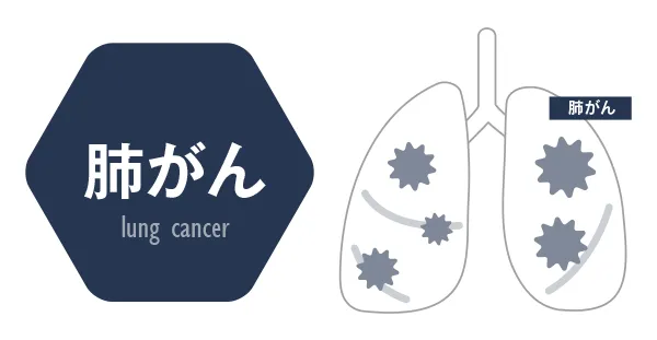 肺がん