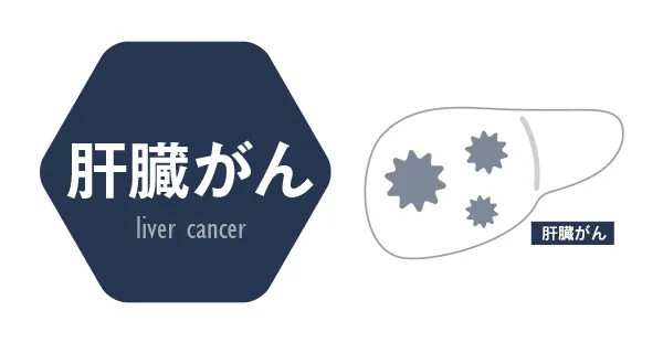肝臓がん