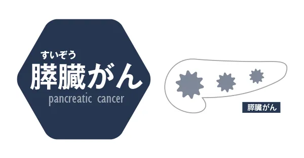 膵臓がん