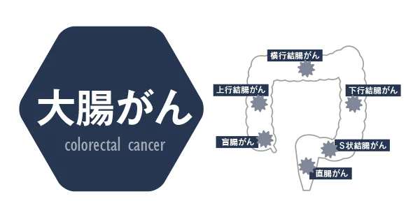 大腸がん