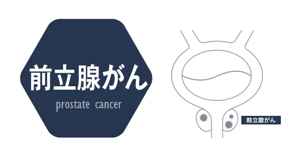 前立腺がん