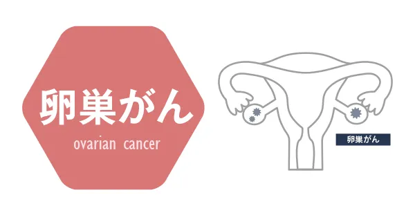 卵巣がん