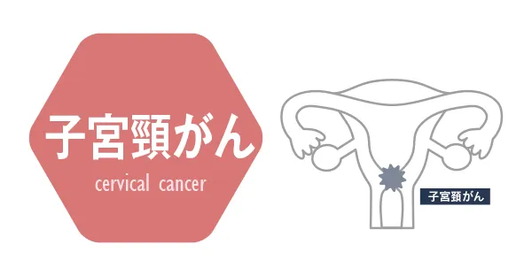 子宮頸がん